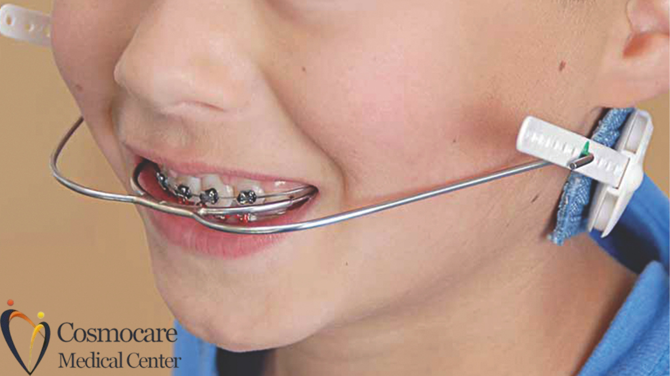 Custom Sports Mouthguards Boxing, Rugby, Sports and Martial Arts in Dubai by Cosmocare Medical Center